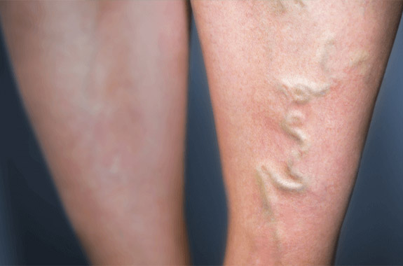 What causes restless legs syndrome?